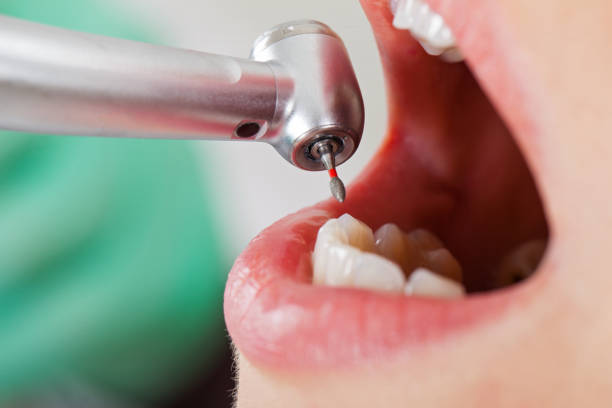 Best Emergency Dental Care for Abscessed Tooth in Washington, IA